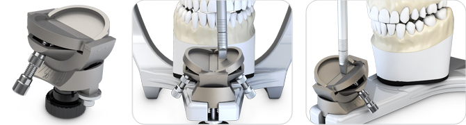 Mesa Incisal ajustable
